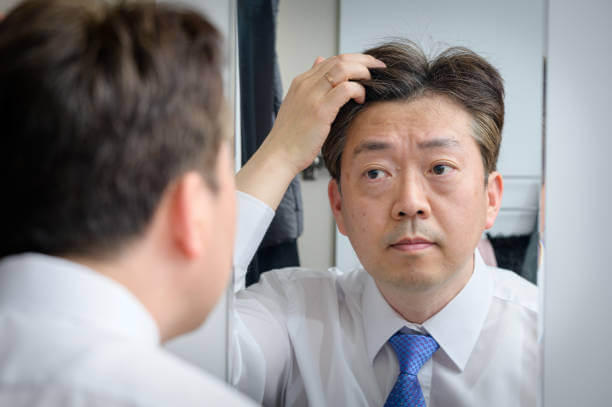 탈모 원인, 환절기 탈모 원형탈모, 휴지기 탈모