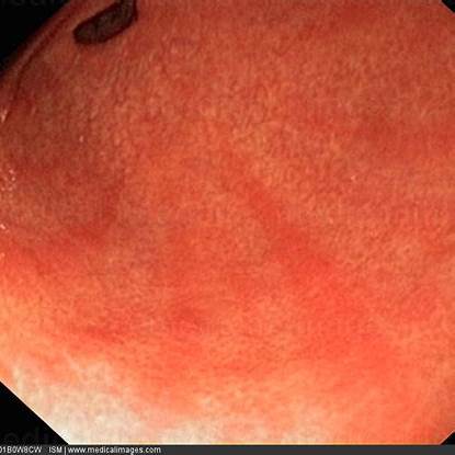 장상피화생 증상과 치료법, 위암 예방을 위한 식습관은?