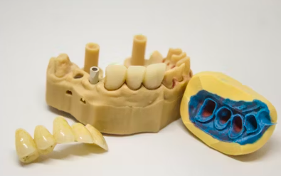임플란트 시술과정 시술기간 시술 종류