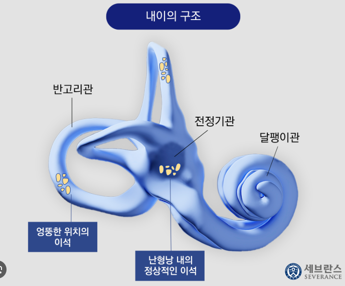 이석증 증상과 자가치료법