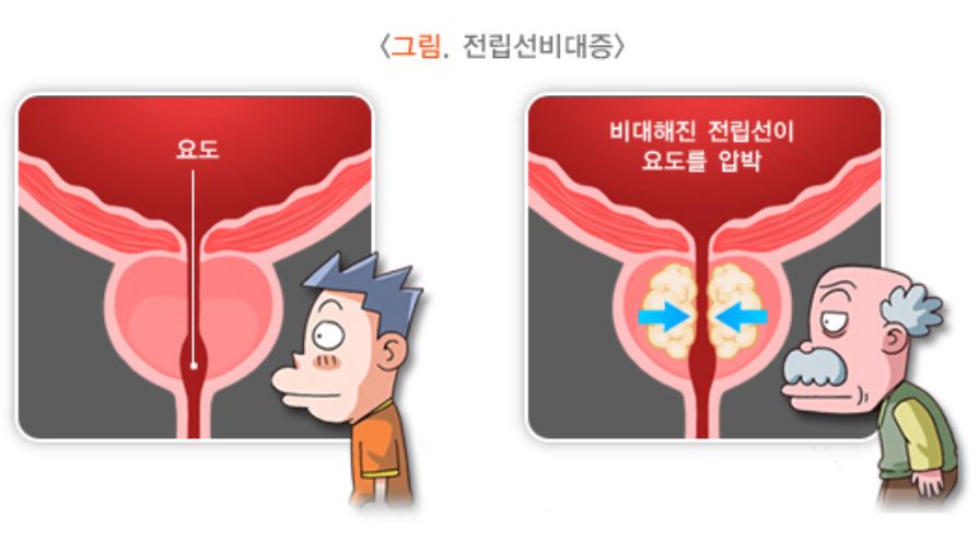 전립선비대증을-표현한-그림