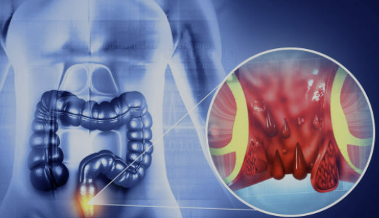 변비에 좋은 음식 해결방법 좋은 운동 등 총정리(24년 Ver)