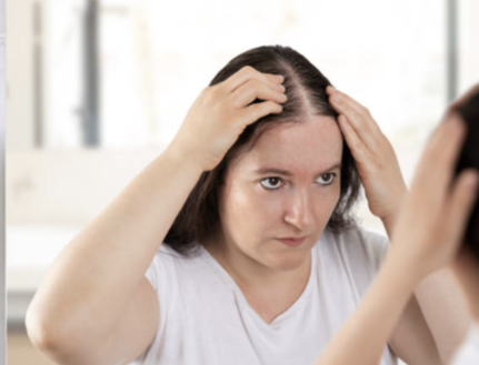 여성 탈모 사진