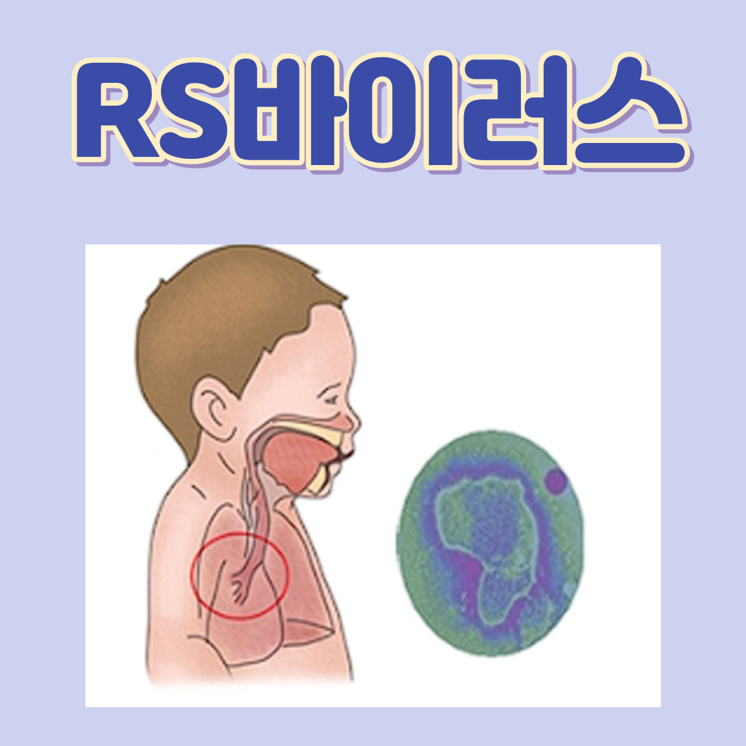 RS바이러스