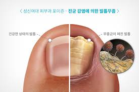 습진 증상과 발생 원인 예방법