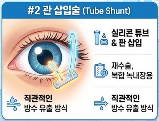 녹내장 수술