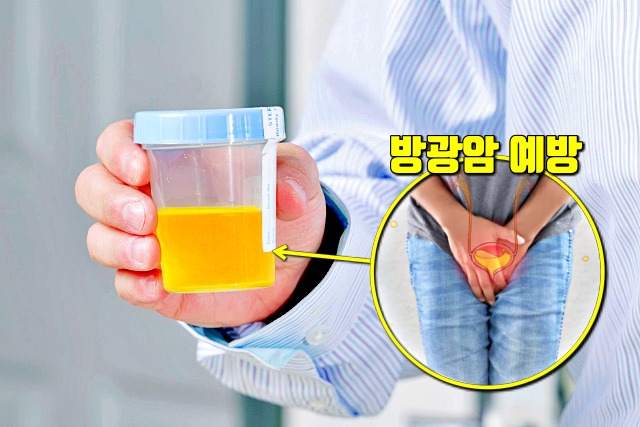 아침 물한잔 효능 효과,방광암,직장암,결장암,신장결석