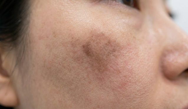 레이저 시술전 색소침착피부