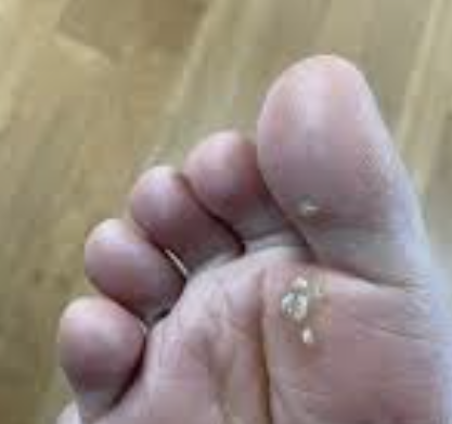 사마귀 제거방법 14