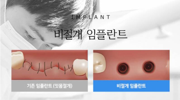 임플란트 지원금
