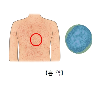 베트남 홍역 증상