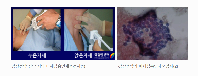 갑상선암 증상, 놓치면 위험한 초기 신호들