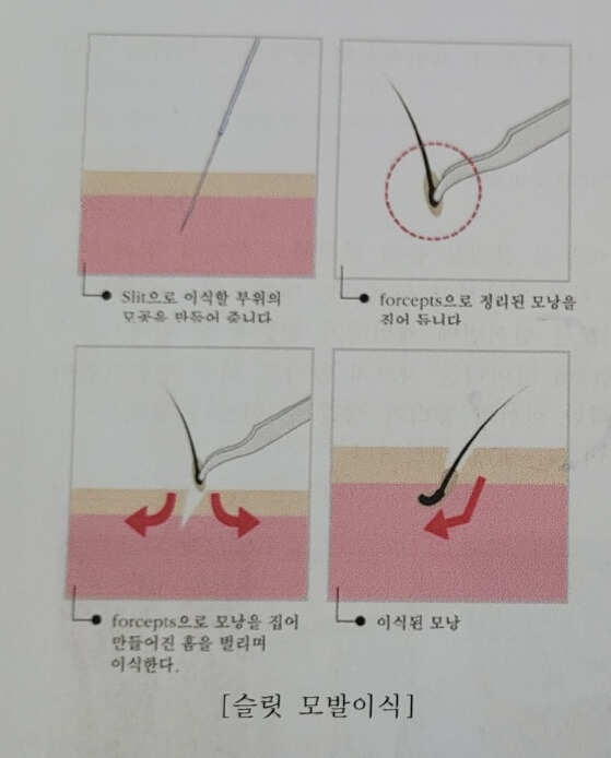 비절개형 모발이식-FUE 이미지