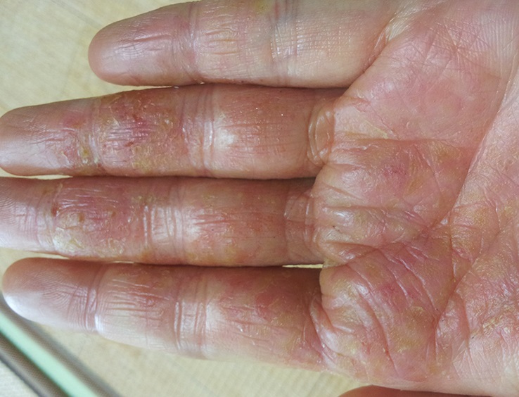 습진에 걸린 손바닥