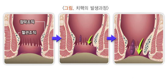 치핵 원인, 증상, 치료방법