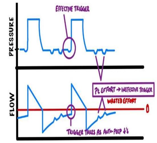 ineffective trigger with air trapping, auto PEEP