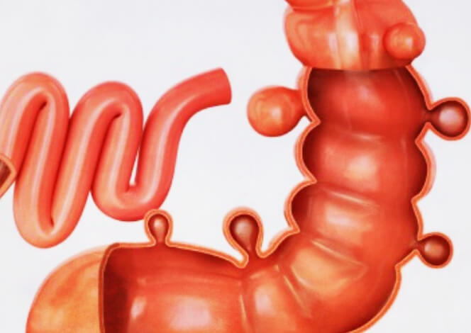 게실이-생긴-대장