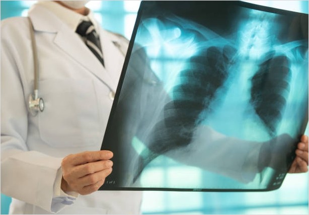 폐암의 초기 증상과 검사 방법