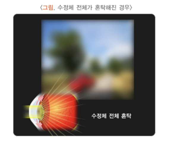 수정체 전체 혼탁