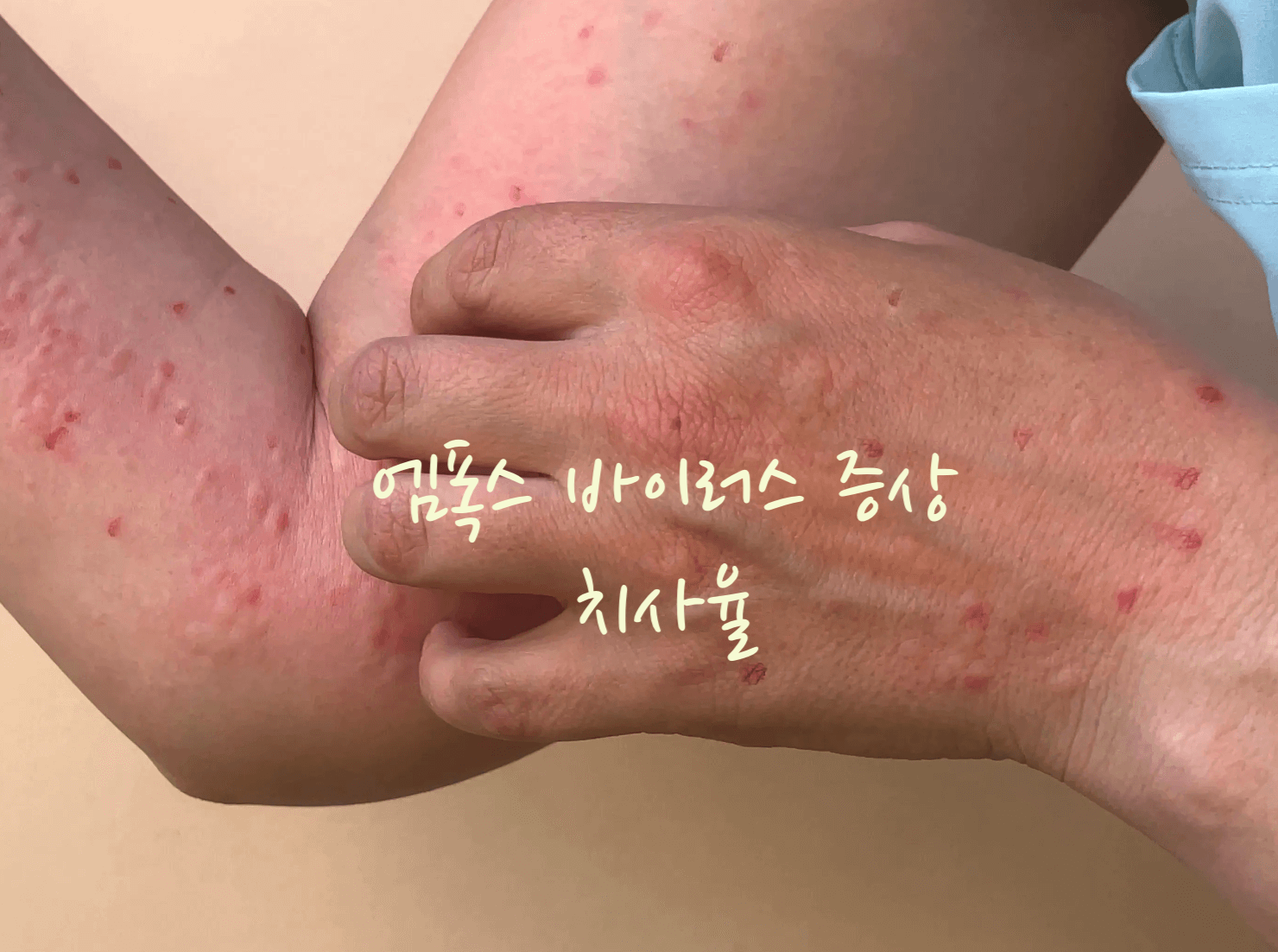 엠폭스