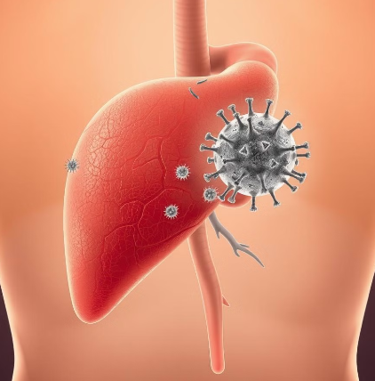  간암 초기일 가능성 높아요 
