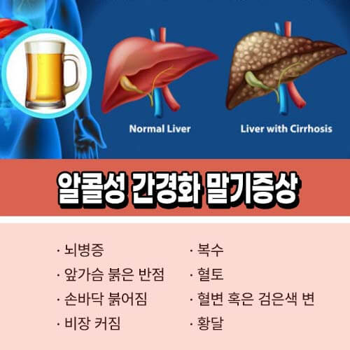 알콜성 간경화 증상