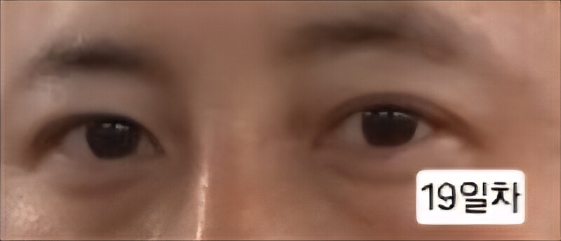 유행성각결막염 치료과정 증상 시력저하 회복과정 발병2주 3주 기록