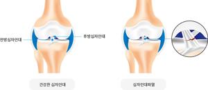 무릎십자인대파열