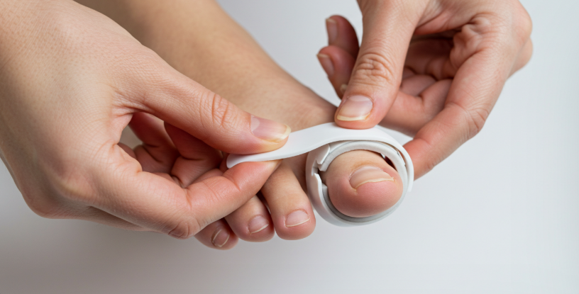 여름철 발 통증, 무지외반증 증상과 조기 치료법