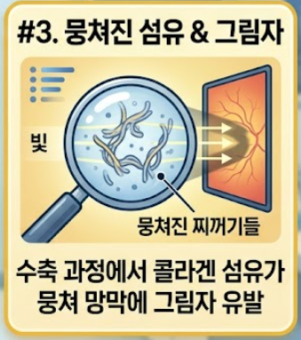 비문증 원인