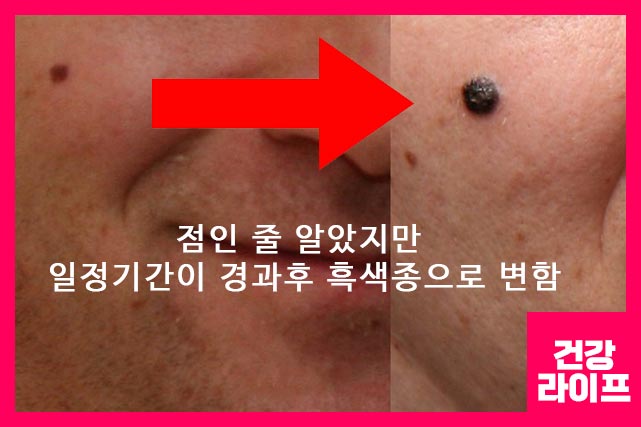 기간이 경과하면 커지는 흑색종