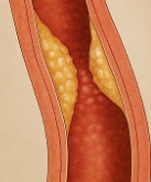 이상지질혈증 이란