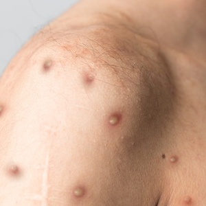 원숭이두창 엠폭스 관련주 대장주 테마주 TOP7