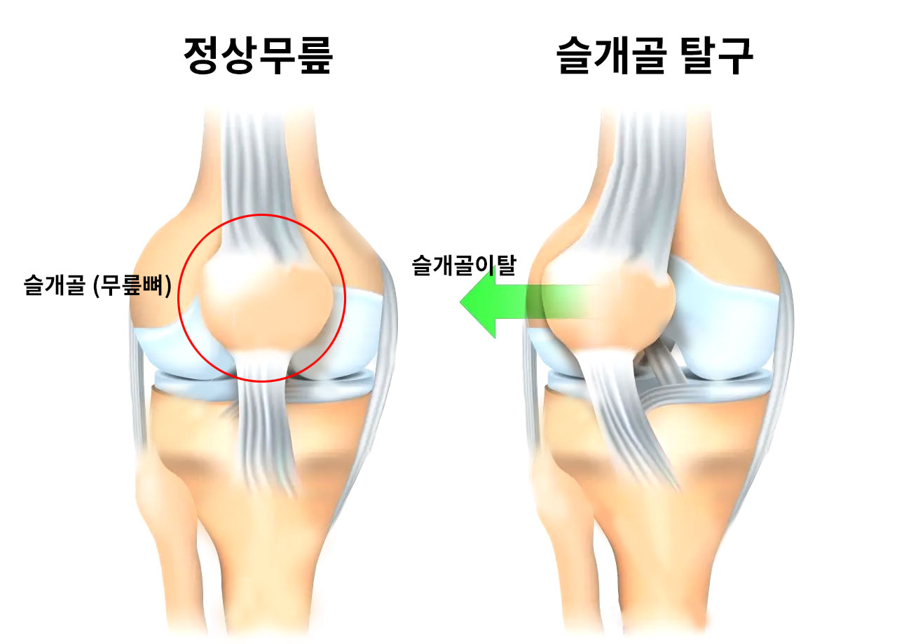 정상무릎과 슬개골 탈구 비교사진