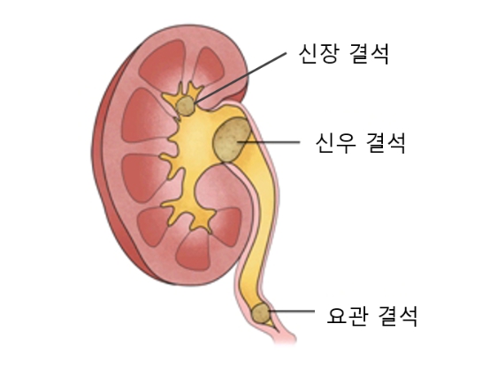 신장결석 / 요로결석