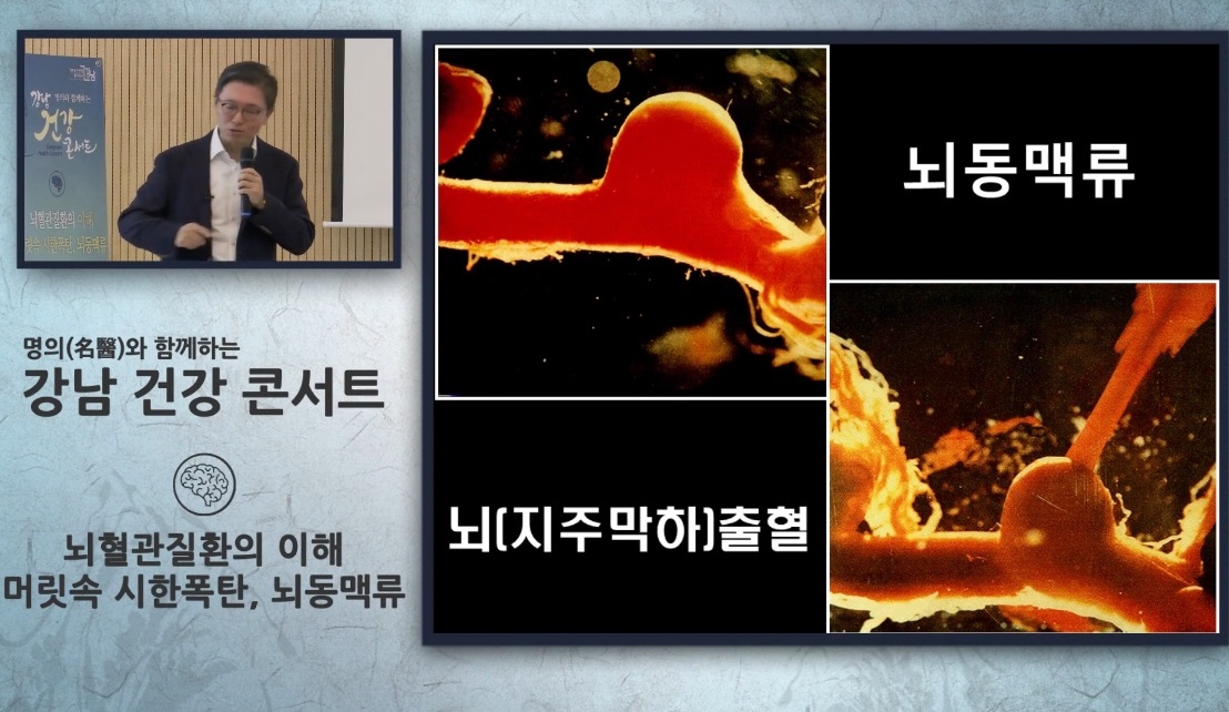 뇌동맥류-김용배-교수