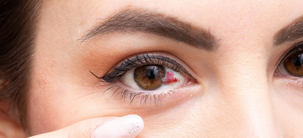 눈 실핏줄 터지는 이유 원인 결막하 출혈 자주 터지는 이유 치료방법