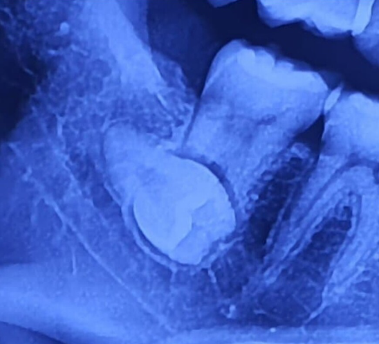 사랑니 발치후 운동 재개 시기
