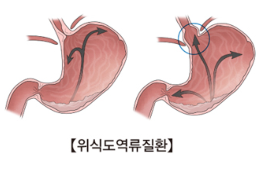 역류성식도염2
