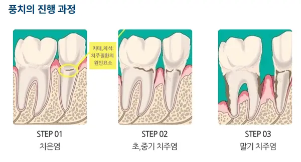 풍치-증상