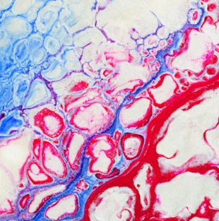 고지혈증에 좋은 음식 나쁜 음식