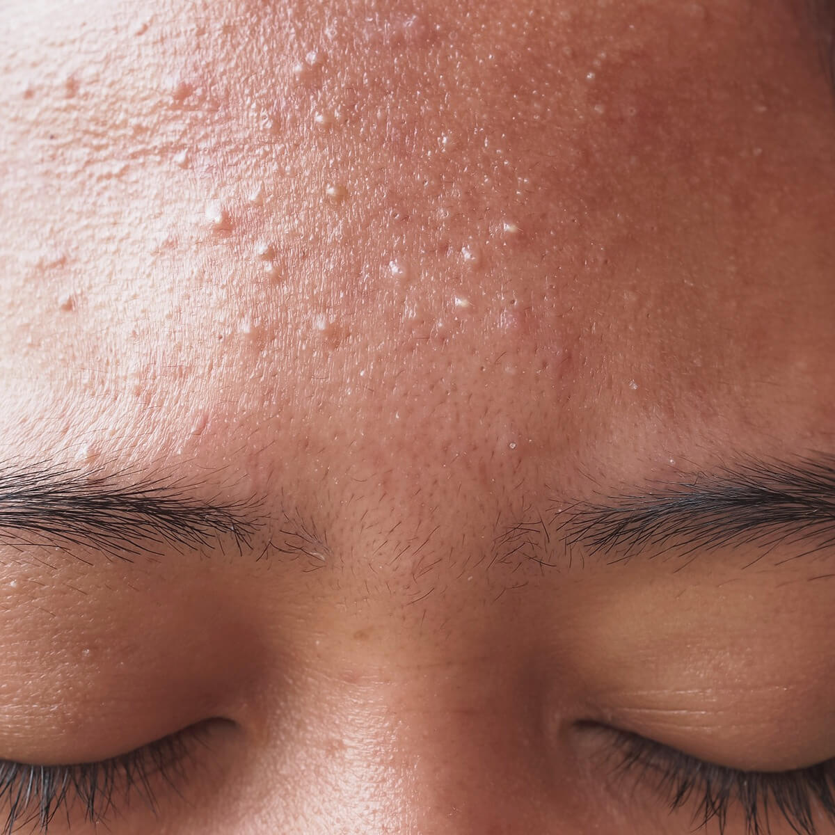 춘기여드름 원인과 청소년여드름 관리 방법을 설명하기위한 이미지로 올바른 세안법과 생활습관 개선에 관한 피부 케어 정보 제공