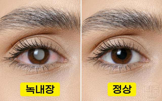 녹내장 원인 녹내장 실명확률