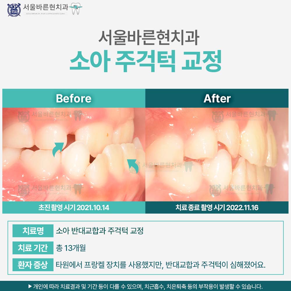 해운대치아교정