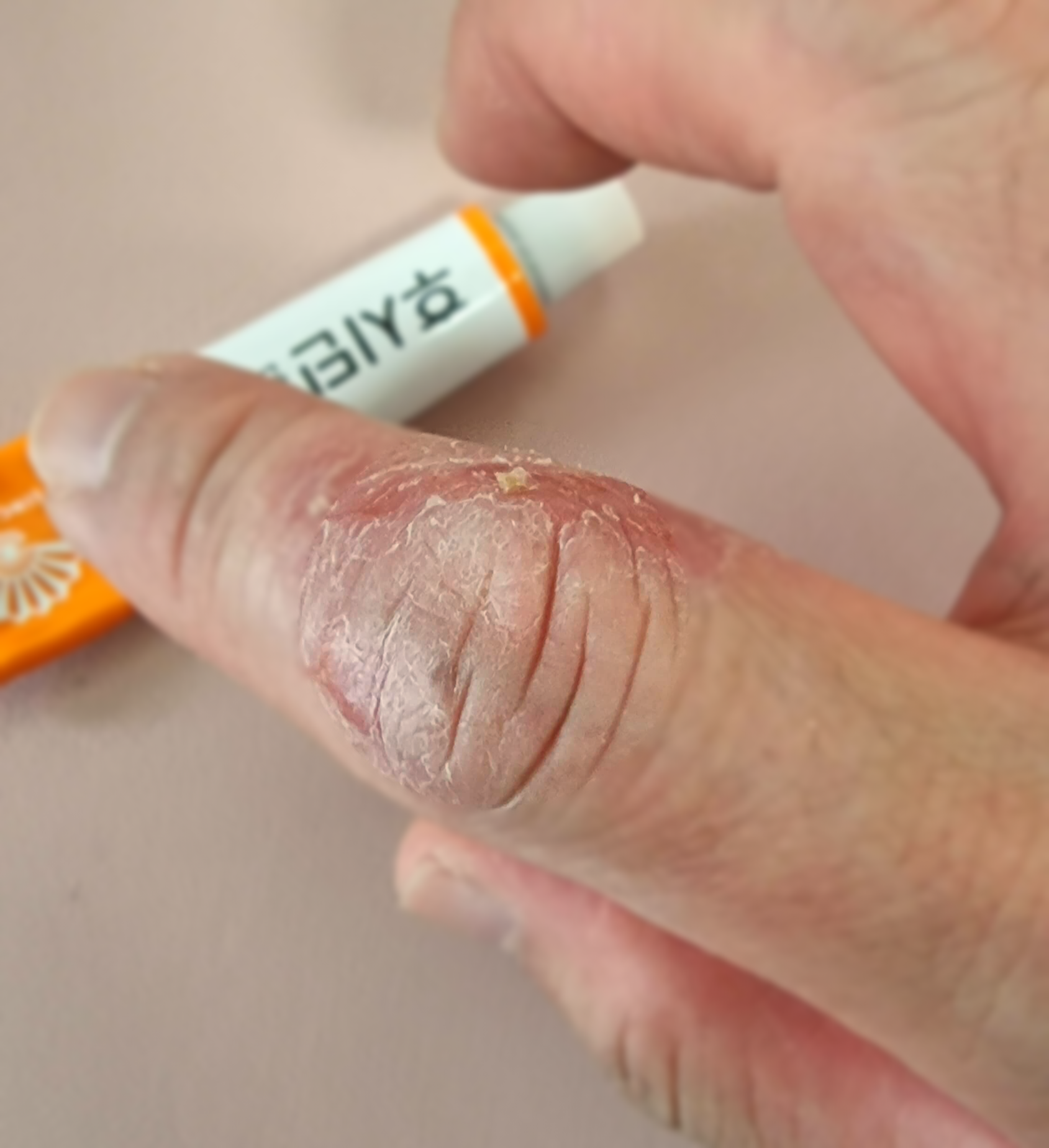 습진이 생긴 손가락