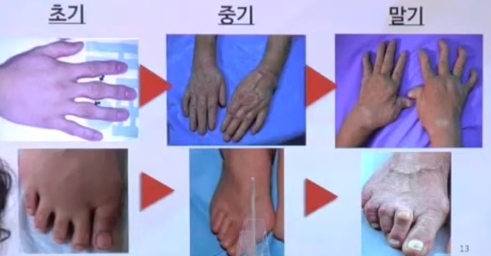 류마티스 진행 과정 사진