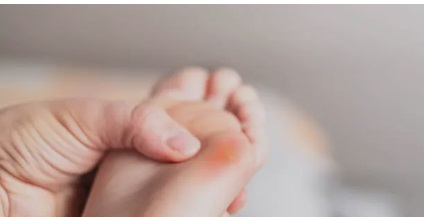 티눈 관려 사진