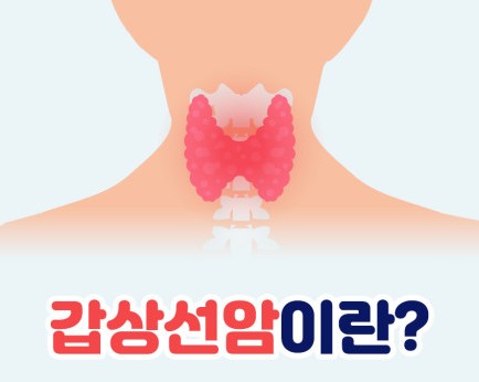 갑상선암을-일러스트로-표현한-이미지