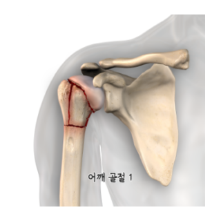 어깨통증원인