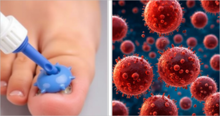 발톱무좀 치료, 어떻게 해야 할까?